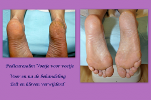 Eelt en kloven Voetje voor voetje