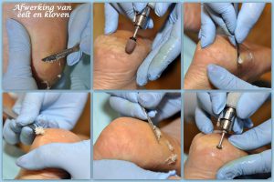 Complete behandeling Pedicuresalon Voetje voor Voetje