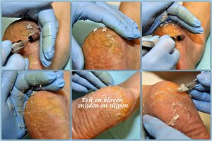Complete behandeling Pedicuresalon Voetje voor Voetje