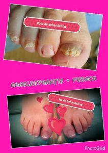Nagelreparatie Pedicuresalon Voetje voor Voetje