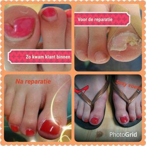 Nagelreparatie Pedicuresalon Voetje voor Voetje