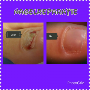 Nagelreparatie Pedicuresalon Voetje voor Voetje