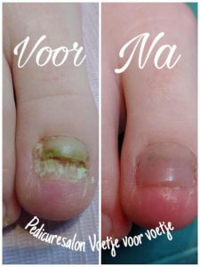 Nagelreparatie Pedicuresalon Voetje voor Voetje