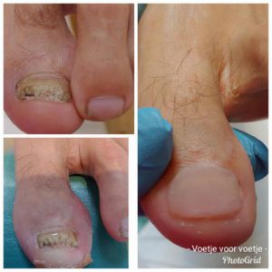 Nagelreparatie Pedicuresalon Voetje voor Voetje