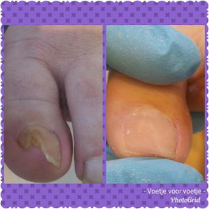 Nagelreparatie Pedicuresalon Voetje voor Voetje