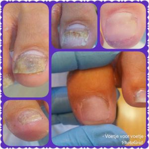 Nagelreparatie Pedicuresalon Voetje voor Voetje