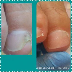 Nagelreparatie Pedicuresalon Voetje voor Voetje
