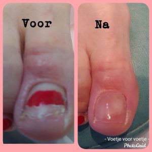 Nagelreparatie Pedicuresalon Voetje voor Voetje